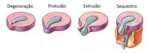 fases-hernia-disco