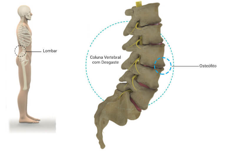Bico de papagaio exibido na ilustração da região lombar e indicando na coluna vertebral um osteófito. 